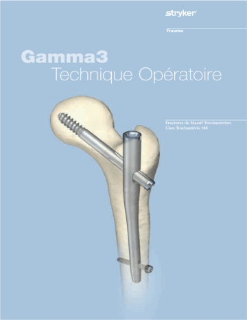 Stryker Gamma3 180 Technique Opératoire | Manualzz