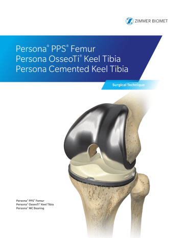 Zimmer Persona OsseoTiKeel Tibia for Cementless Knee Replacement Owner ...